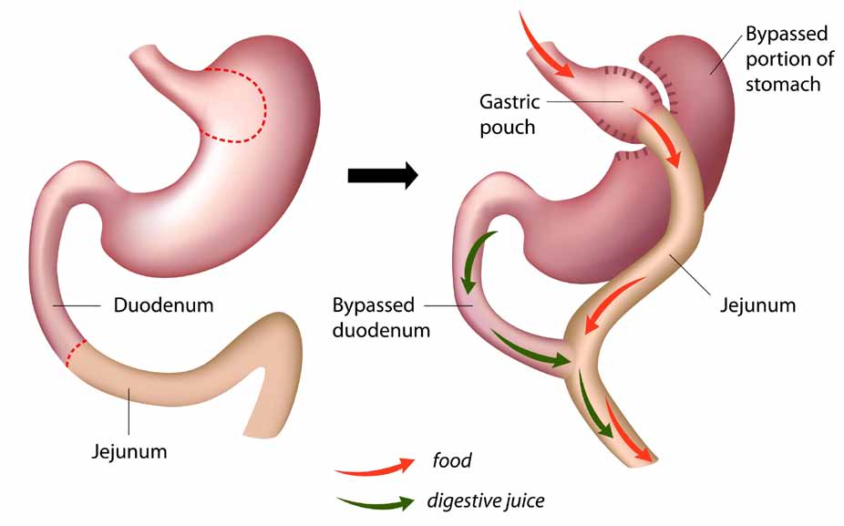 Is Weight Loss Surgery For You?3